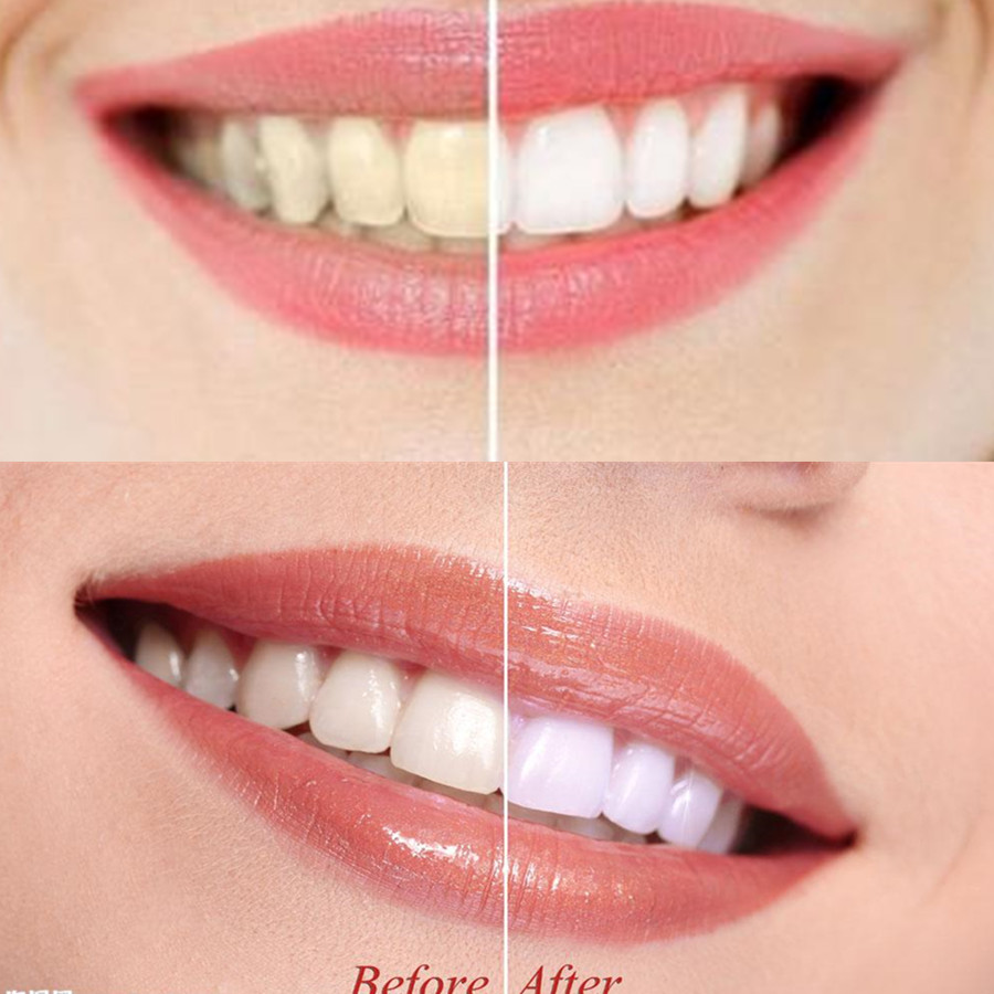 ถ่านไม้ไผ่ฟันฟันทันตกรรมสูตร L - Teeth Whitening Price บทวิจารณ์และราคา