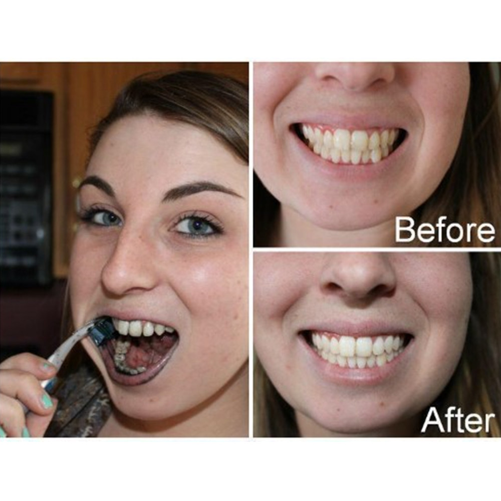 ถ่านไม้ไผ่ฟันฟันทันตกรรมสูตร L - Teeth Whitening Price บทวิจารณ์และราคา