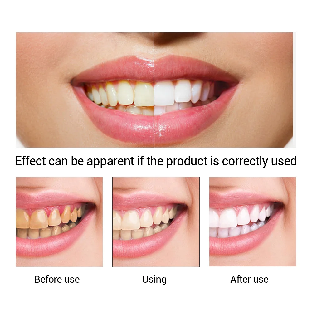 FTEENPLY ฟันไวท์เทนนิ่ง Oral ส - Teeth Whitening Street บทวิจารณ์และราคา
